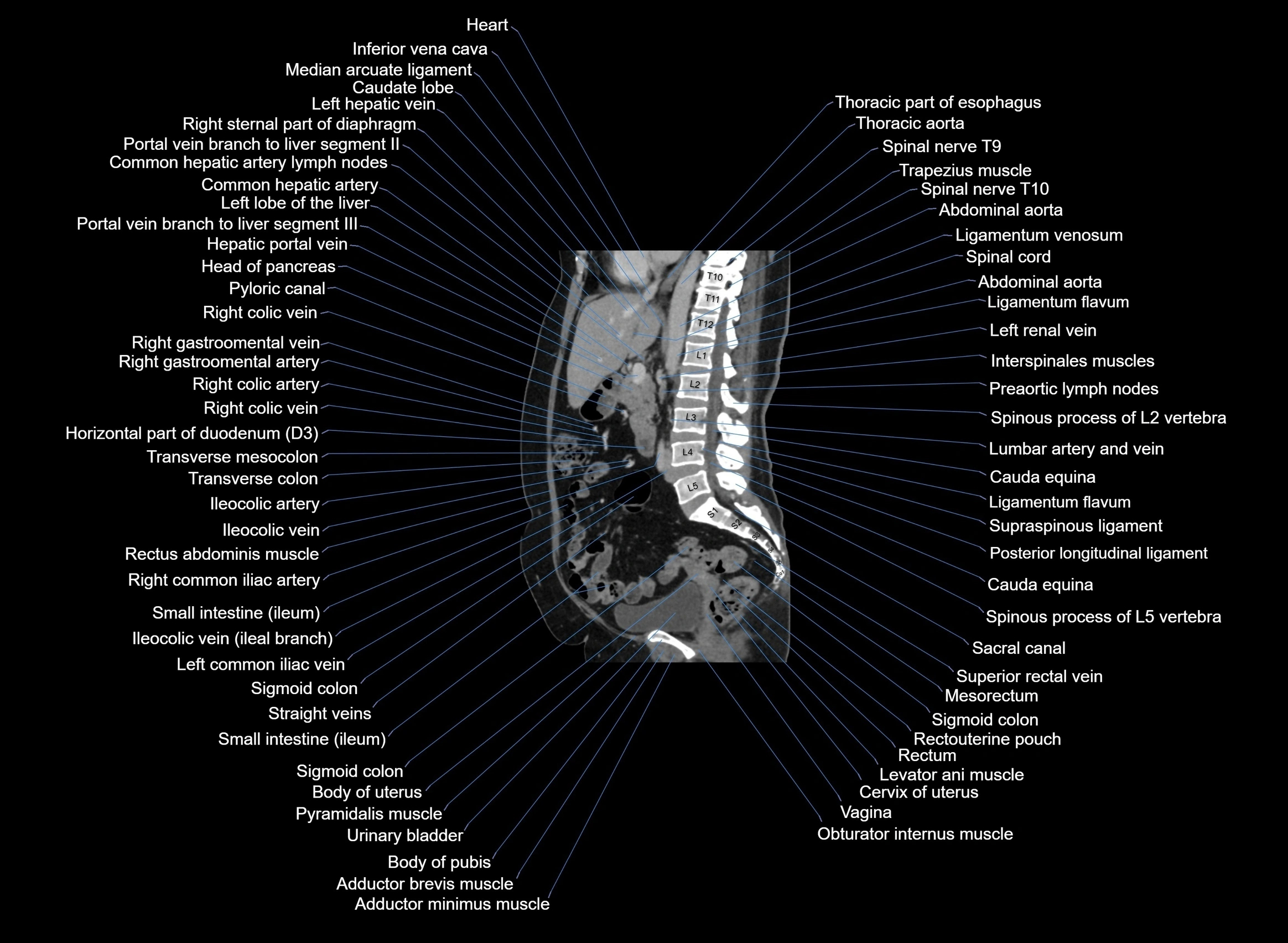 CT Abdomen sagittal cross sectional anatomy labelled radiology image -00061.webp
